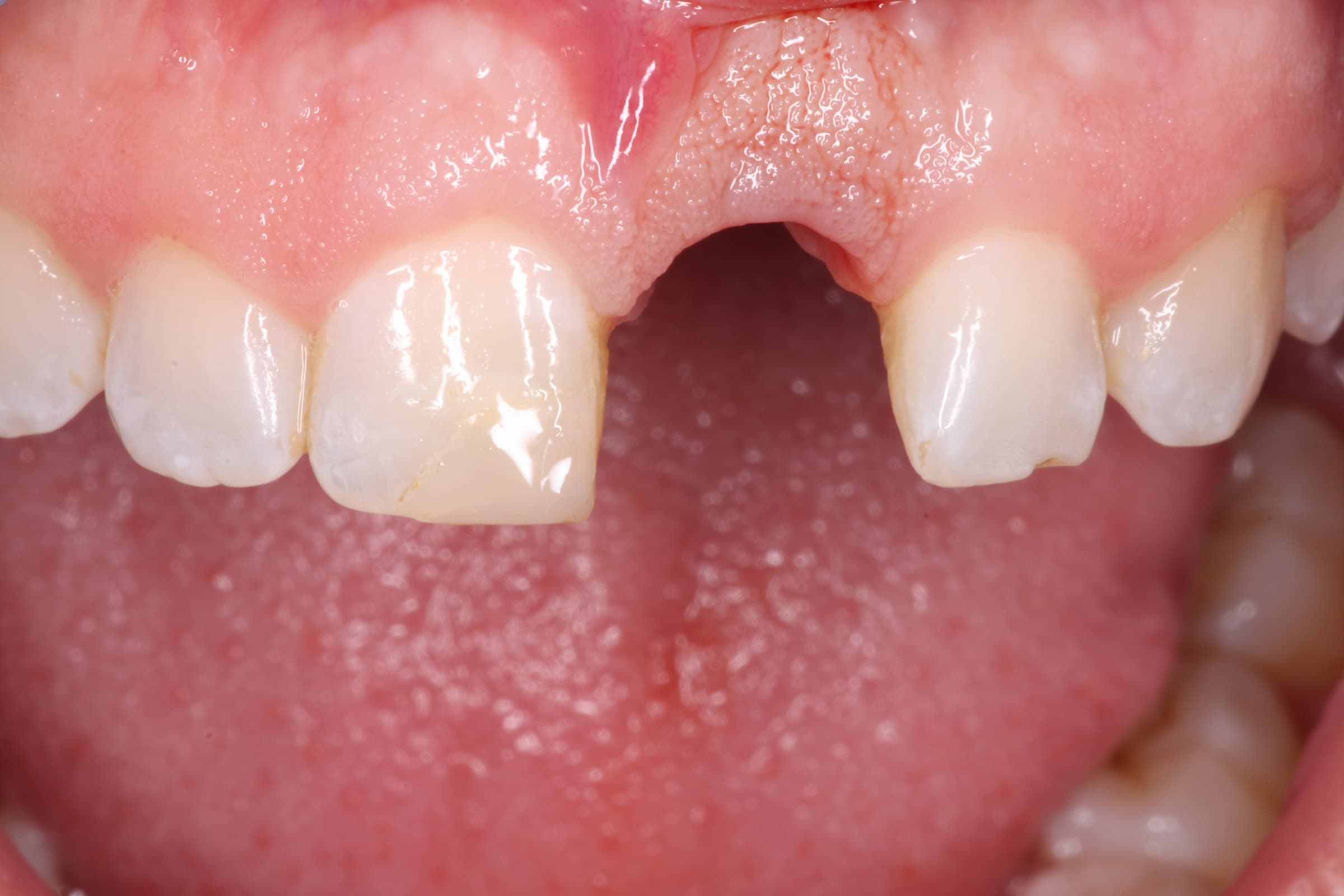 Antes del tratamiento - Rehabilitación Implantosoportada