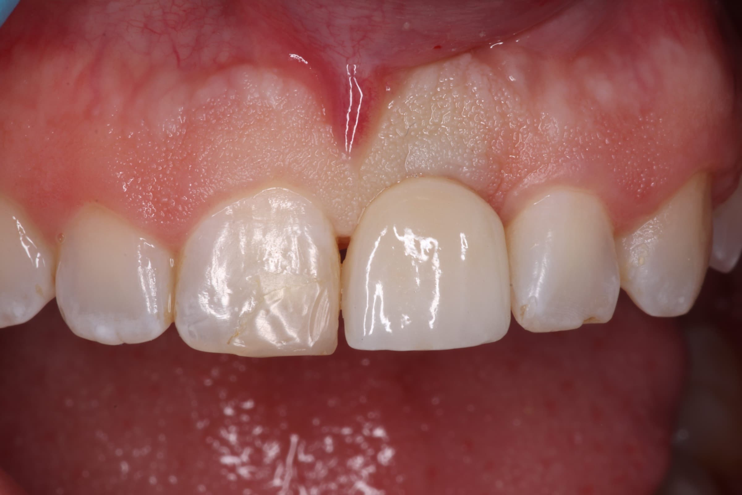 Resultado del tratamiento - Rehabilitación Implantosoportada