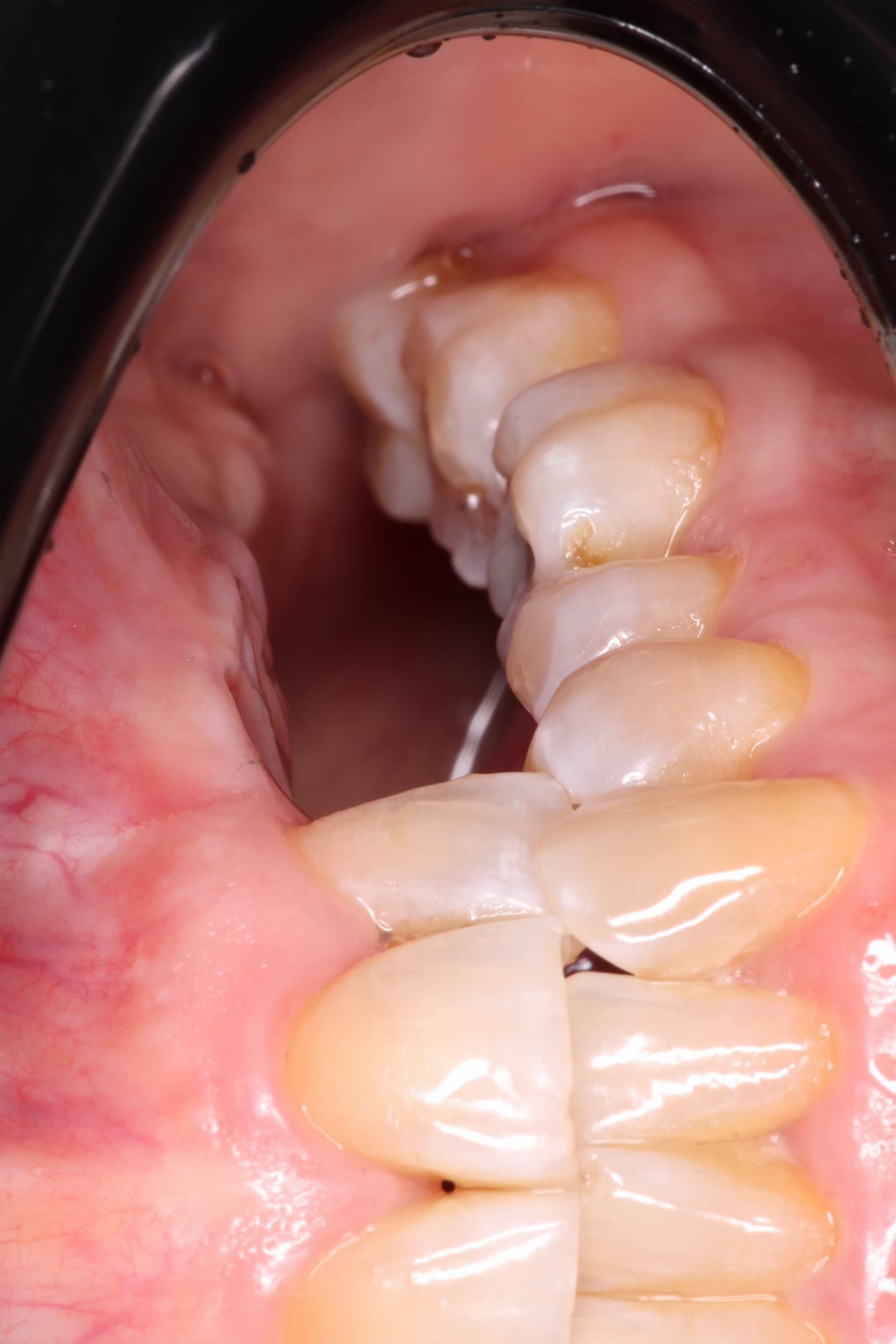 Antes del tratamiento - Implante Unitario Sector Anterior
