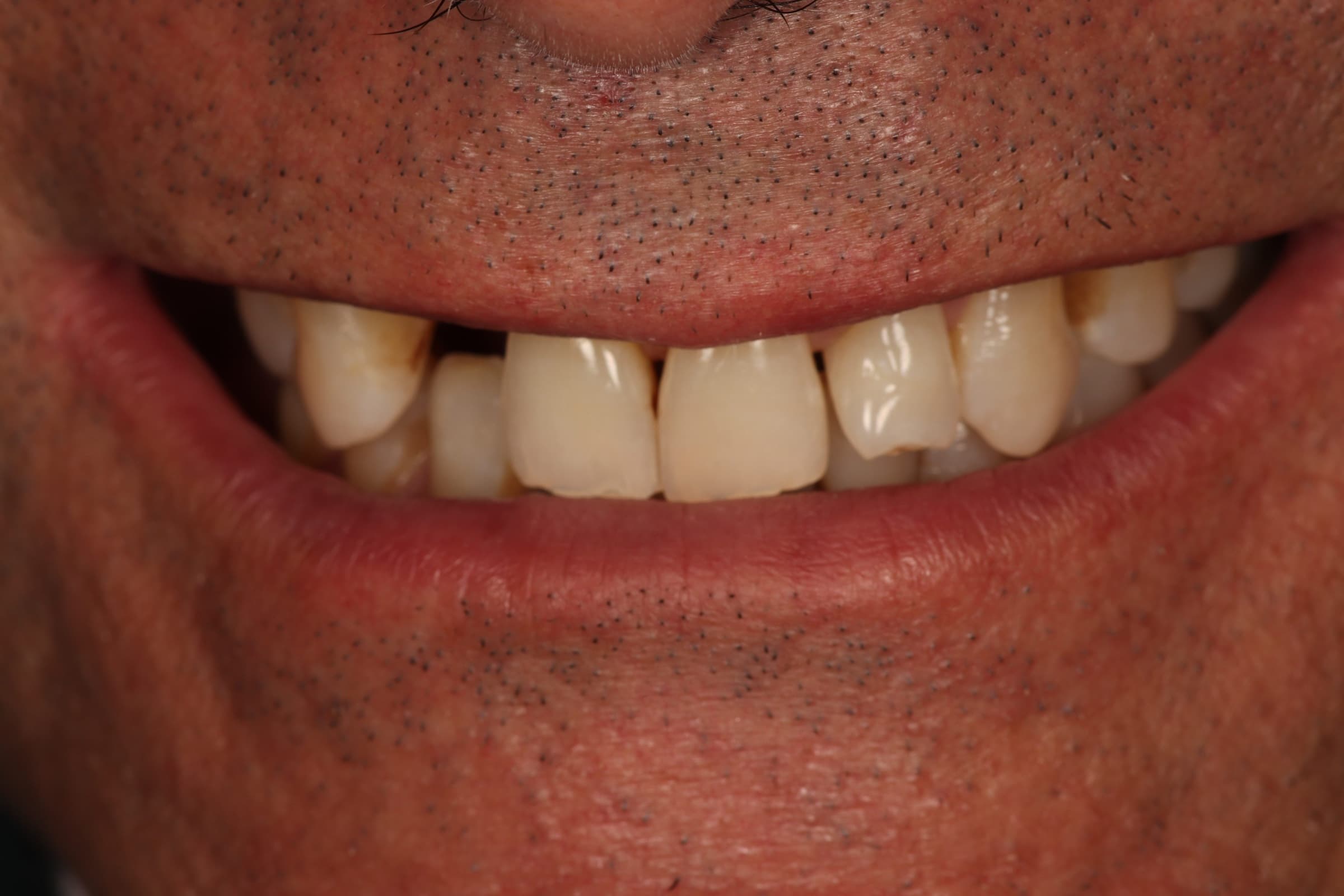 Antes del tratamiento - Rehabilitación Oral Completa