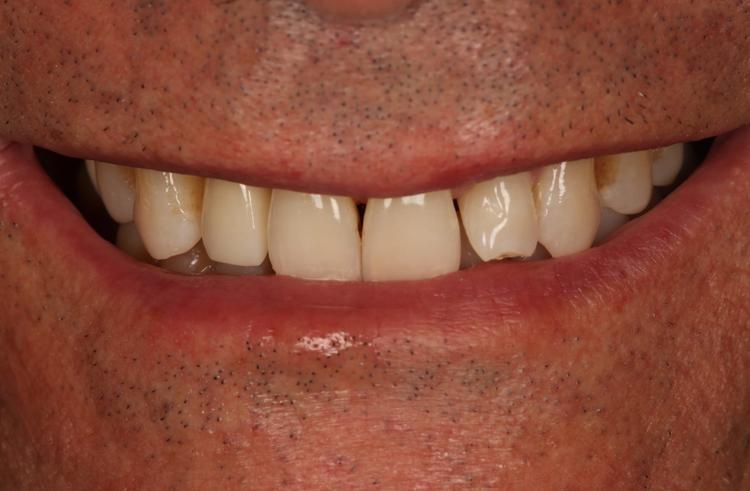 Resultado del tratamiento - Rehabilitación Oral Completa