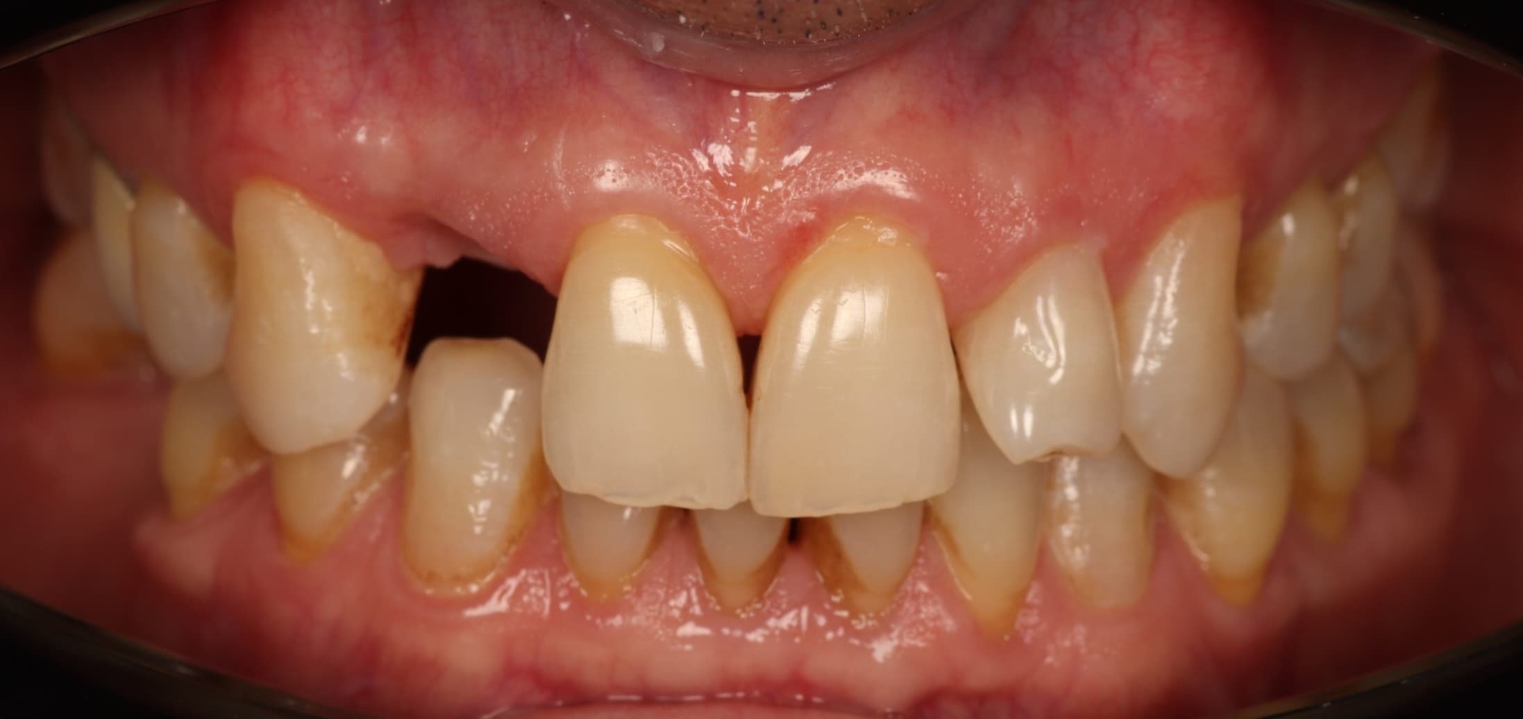 Antes del tratamiento - Implante Inmediato Sector Anterior