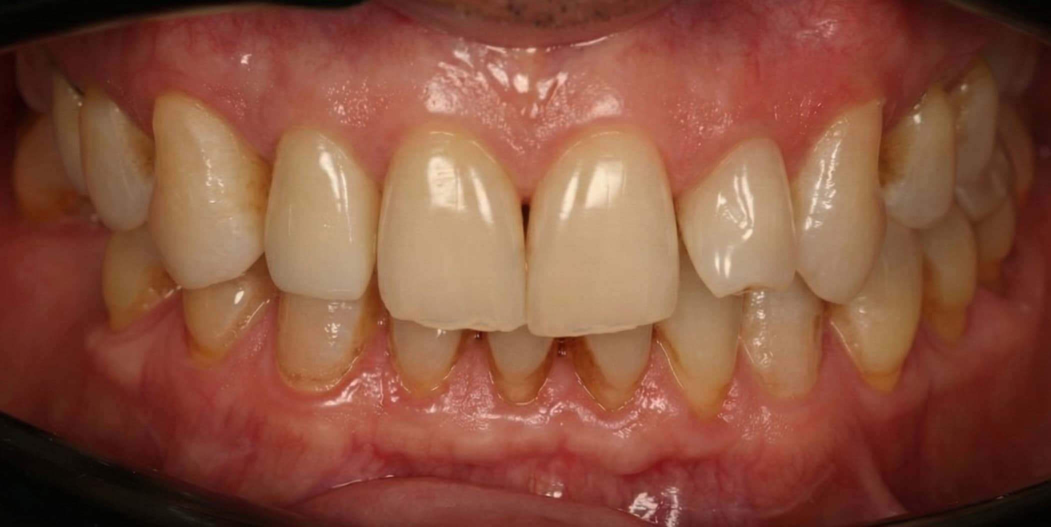 Resultado del tratamiento - Implante Inmediato Sector Anterior