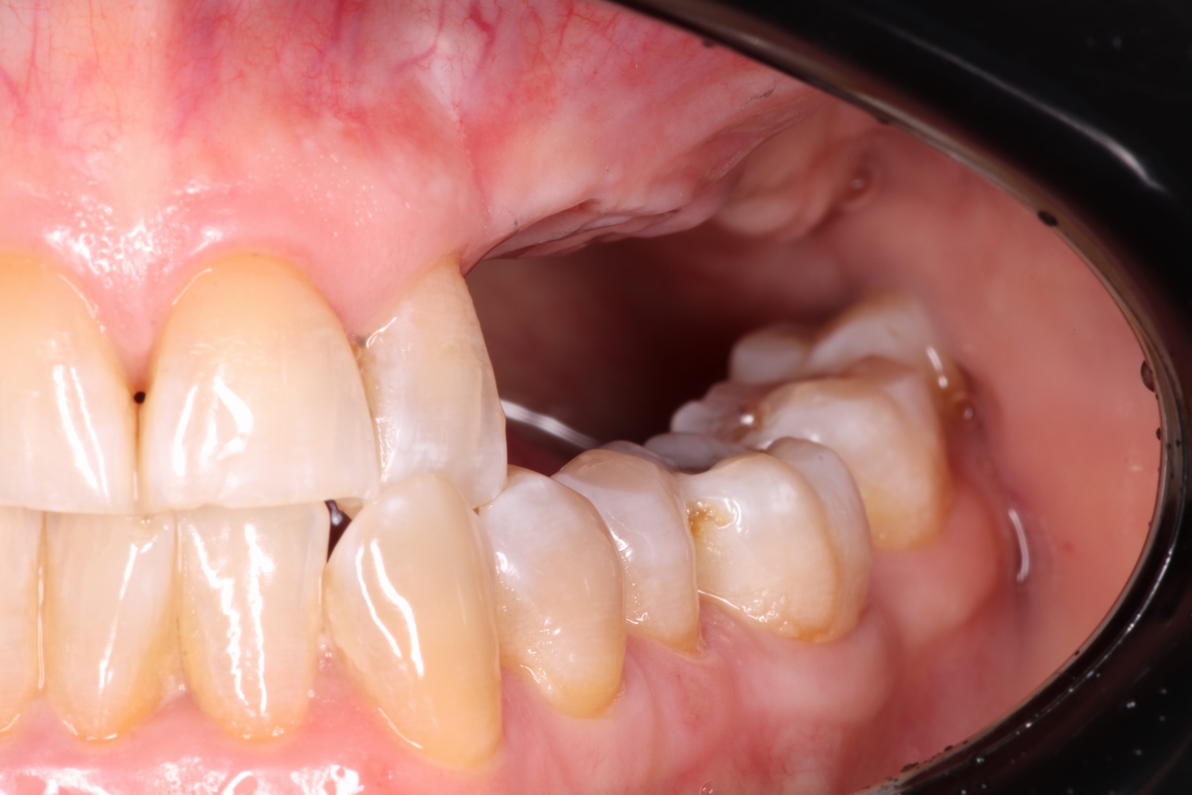 Antes del tratamiento - Rehabilitación Implantosoportada