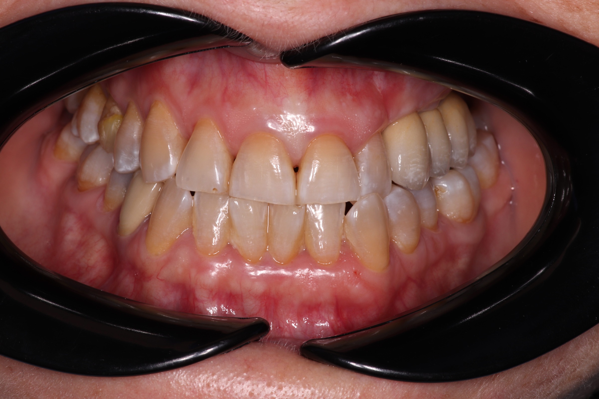 Resultado del tratamiento - Rehabilitación Implantosoportada