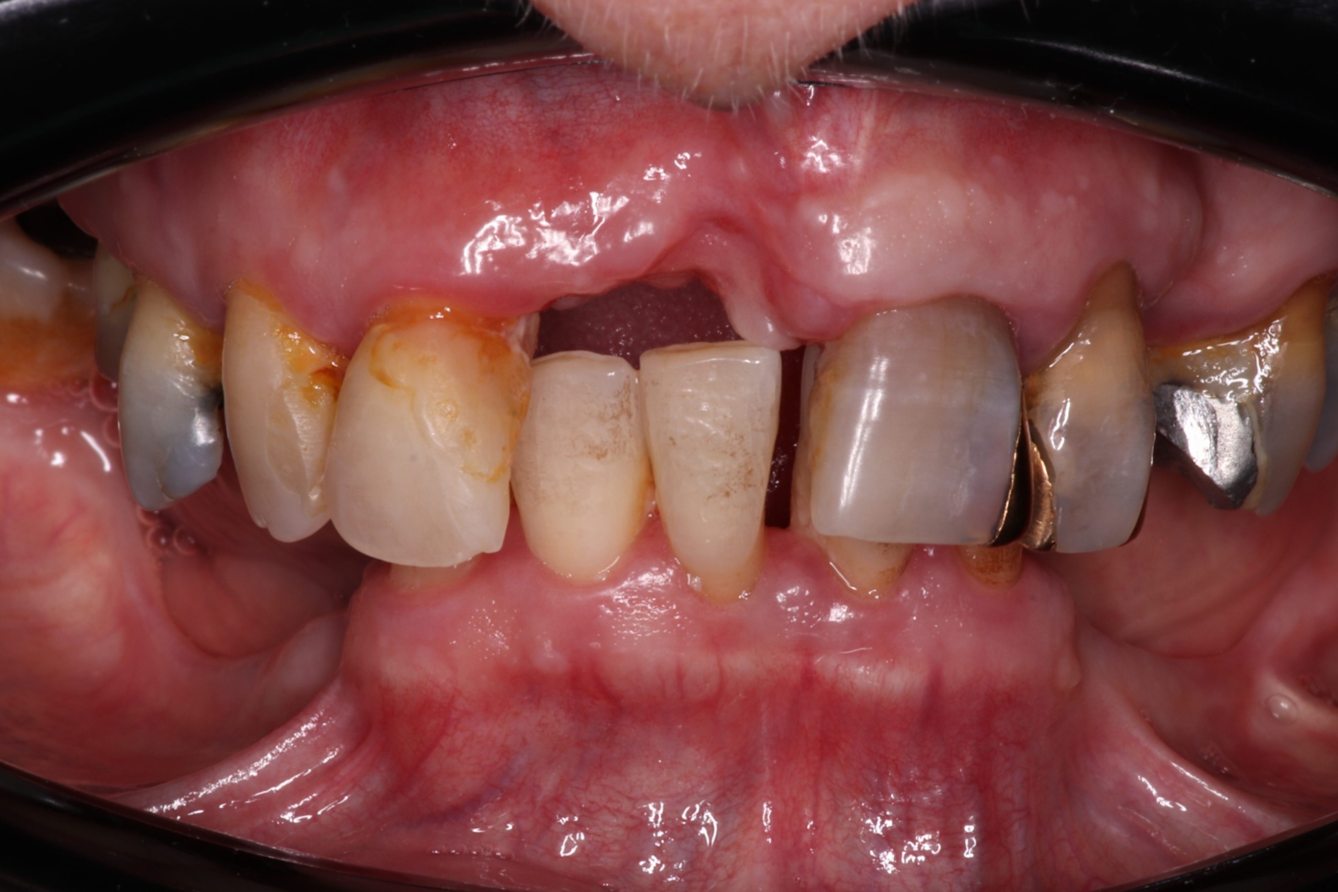 Antes del tratamiento - Rehabilitación Oral Completa