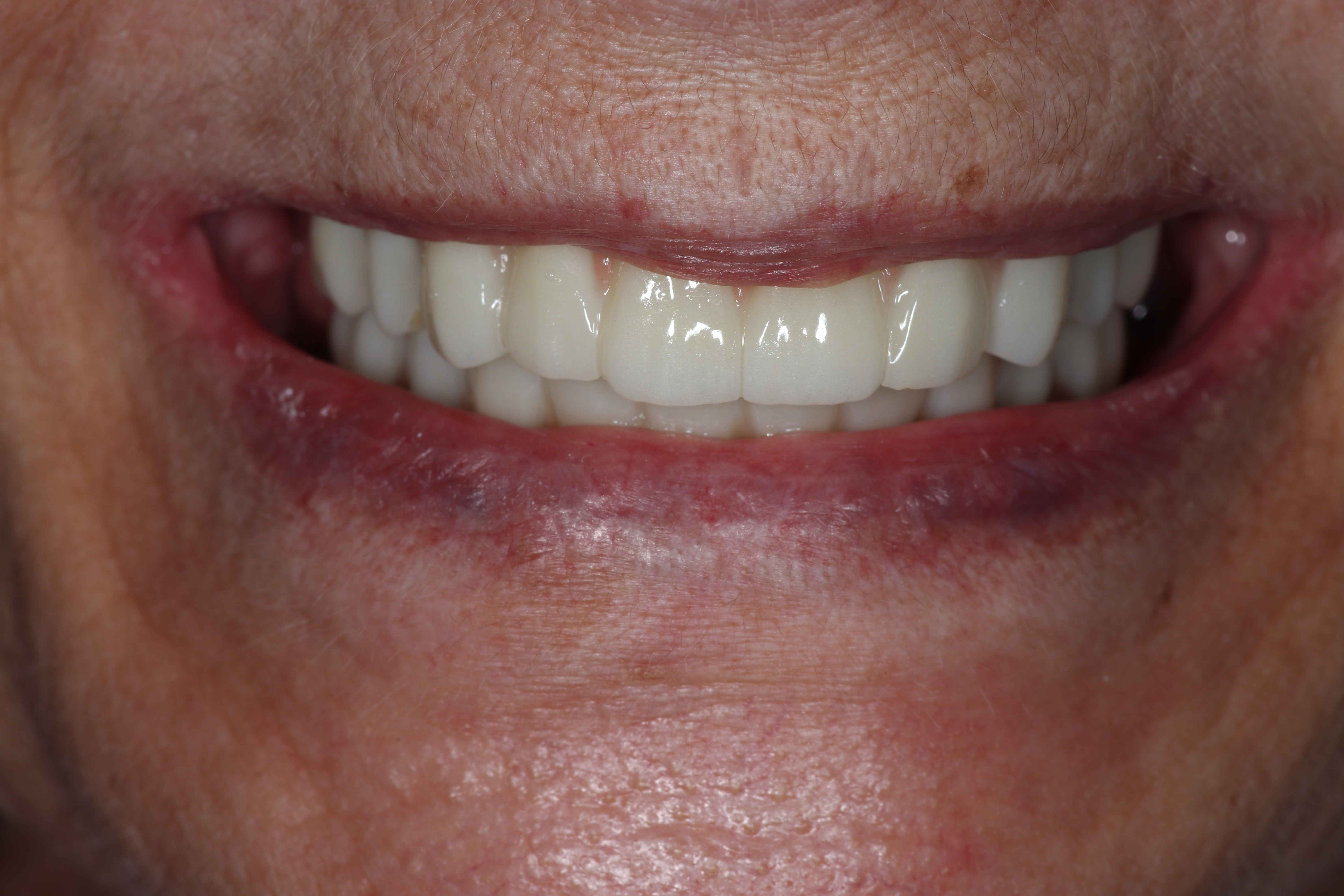 Resultado del tratamiento - Rehabilitación Oral Completa